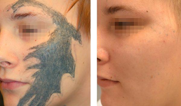 Laser Tattoo Removal in NYC, Westchester & Bronx by Studio Esthetique Tattoo  Removal Center